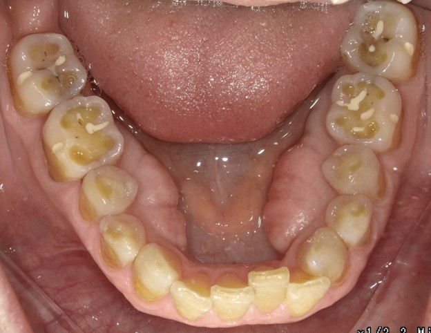 Photo 1 of teeth before