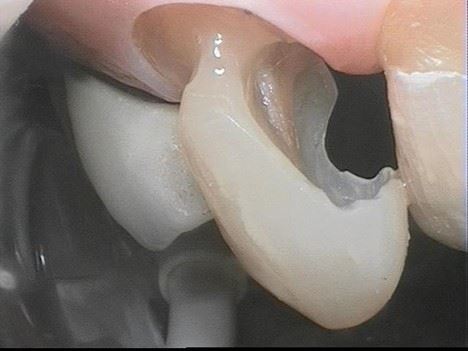 hole in tooth
