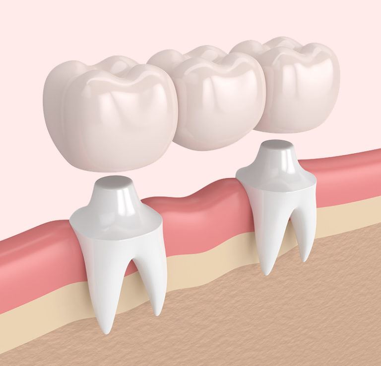 Dental Bridge Example