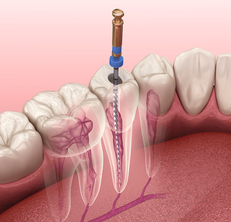 Root canal digital example
