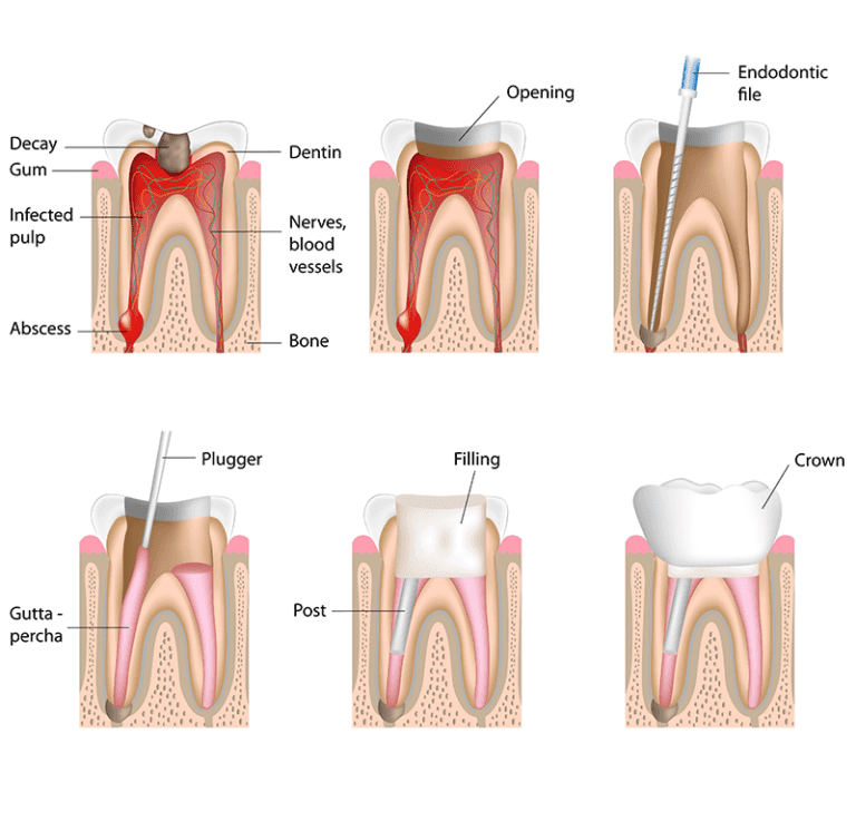 Root canal infographic