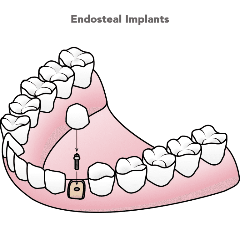 Endosteal implant example
