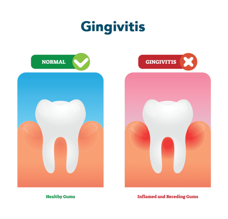 Gingivitis infographic