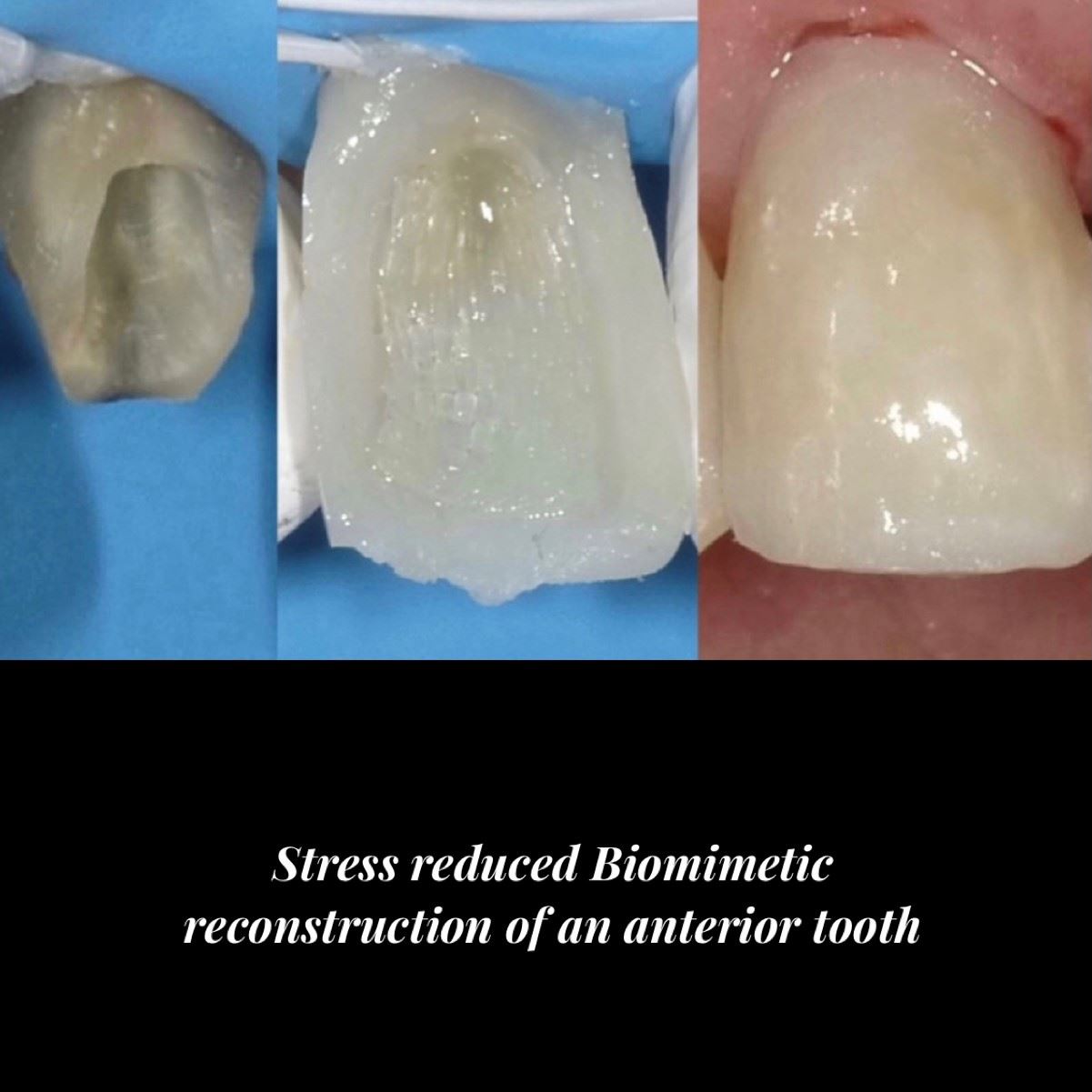 Biomimetic Reconstruction - Anterior Tooth