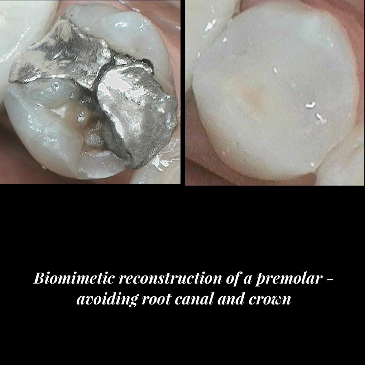 Biomimetic Reconstruction - Premolar