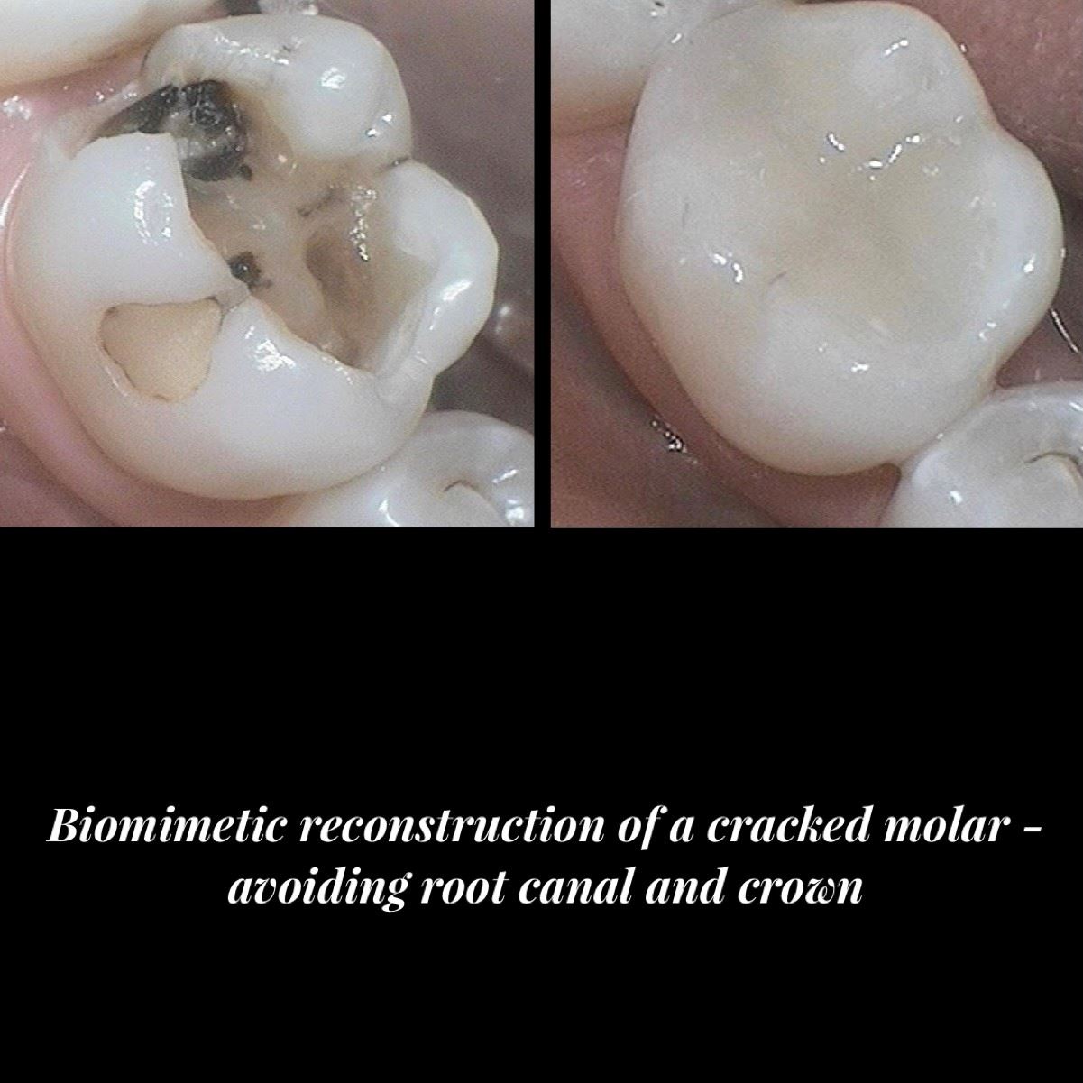 Biomimetic Reconstruction - Cracked Molar