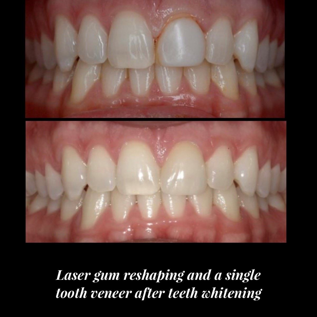 Laser Gum Reshaping, Single Tooth Veneer & Teeth Whitening