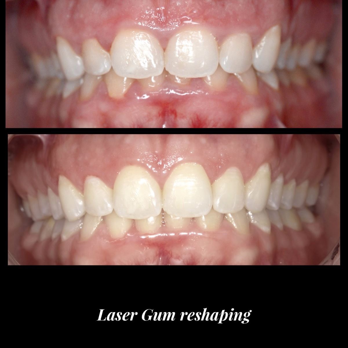 Laser Gum Reshaping Patient